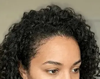 After — Scalp microneedling — part-line density improvement